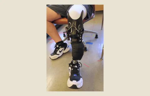 Leg with prosthetic socket